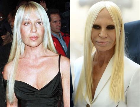 donatella versace before and after plastic surgery|Versace sister plastic surgery.